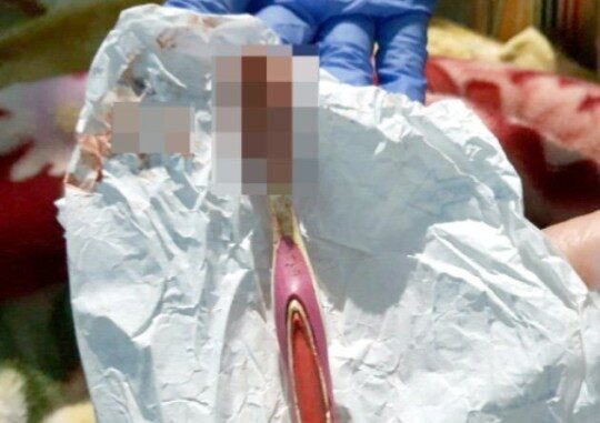 SHOCKER: Doctors Remove Toothbrush From a Man’s Stomach after Swallowing it Whiles Brushing -SEE PHOTOS