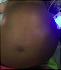 distended stomach Man Got Pregnant After Supposedly Ch0pping Someone’s Wife -WATCH